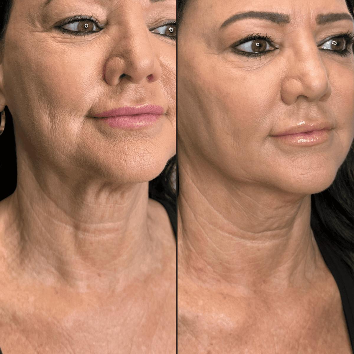 Neck Before & After Gallery - Patient 505320 - Image 2