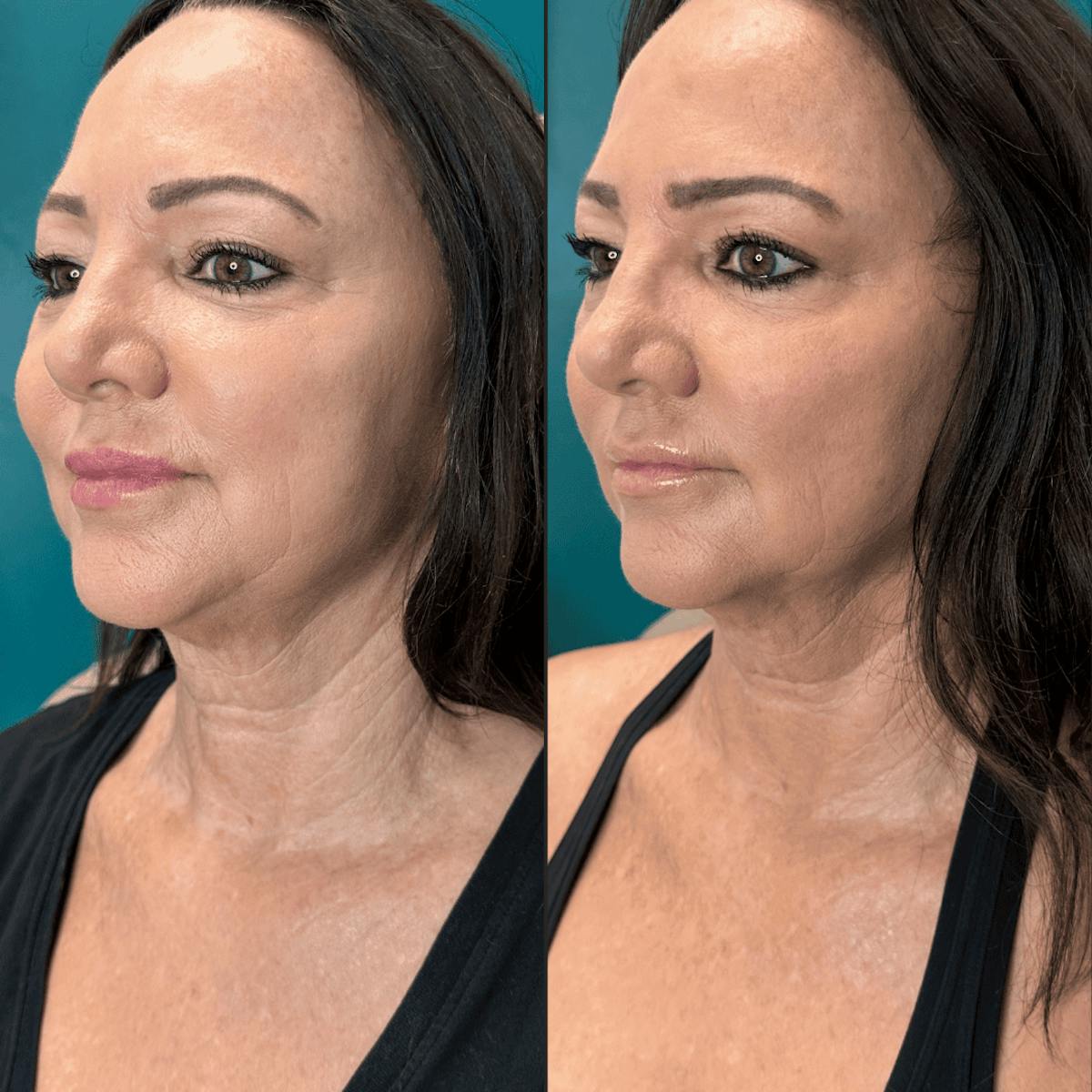 Neck Before & After Gallery - Patient 505320 - Image 4