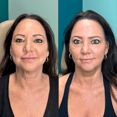 Neck Before & After Gallery - Patient 505320 - Image 1