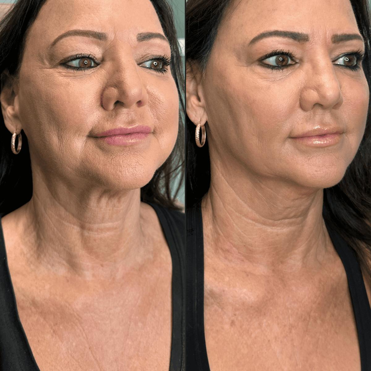 Neck Before & After Gallery - Patient 505320 - Image 12