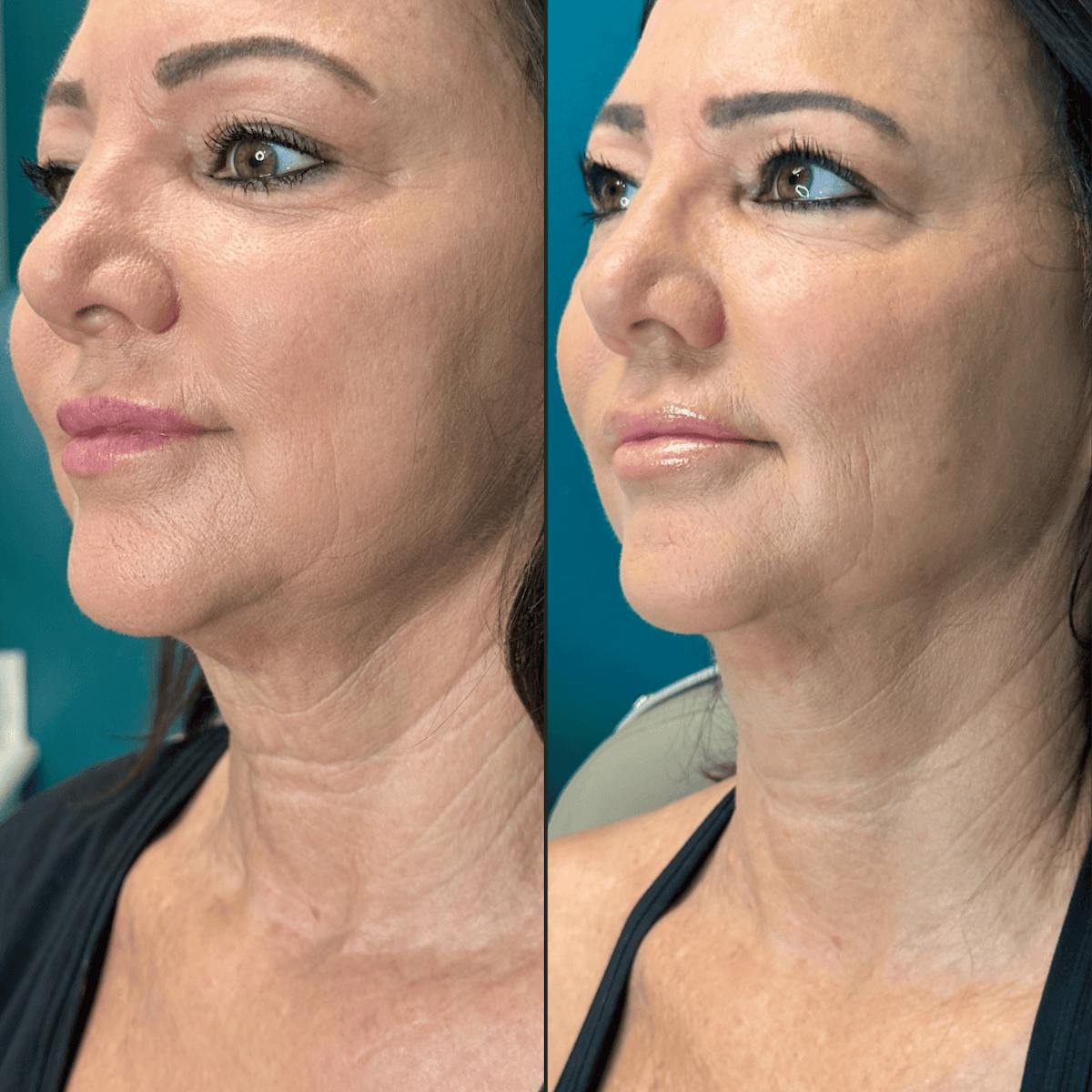 Neck Before & After Gallery - Patient 505320 - Image 11