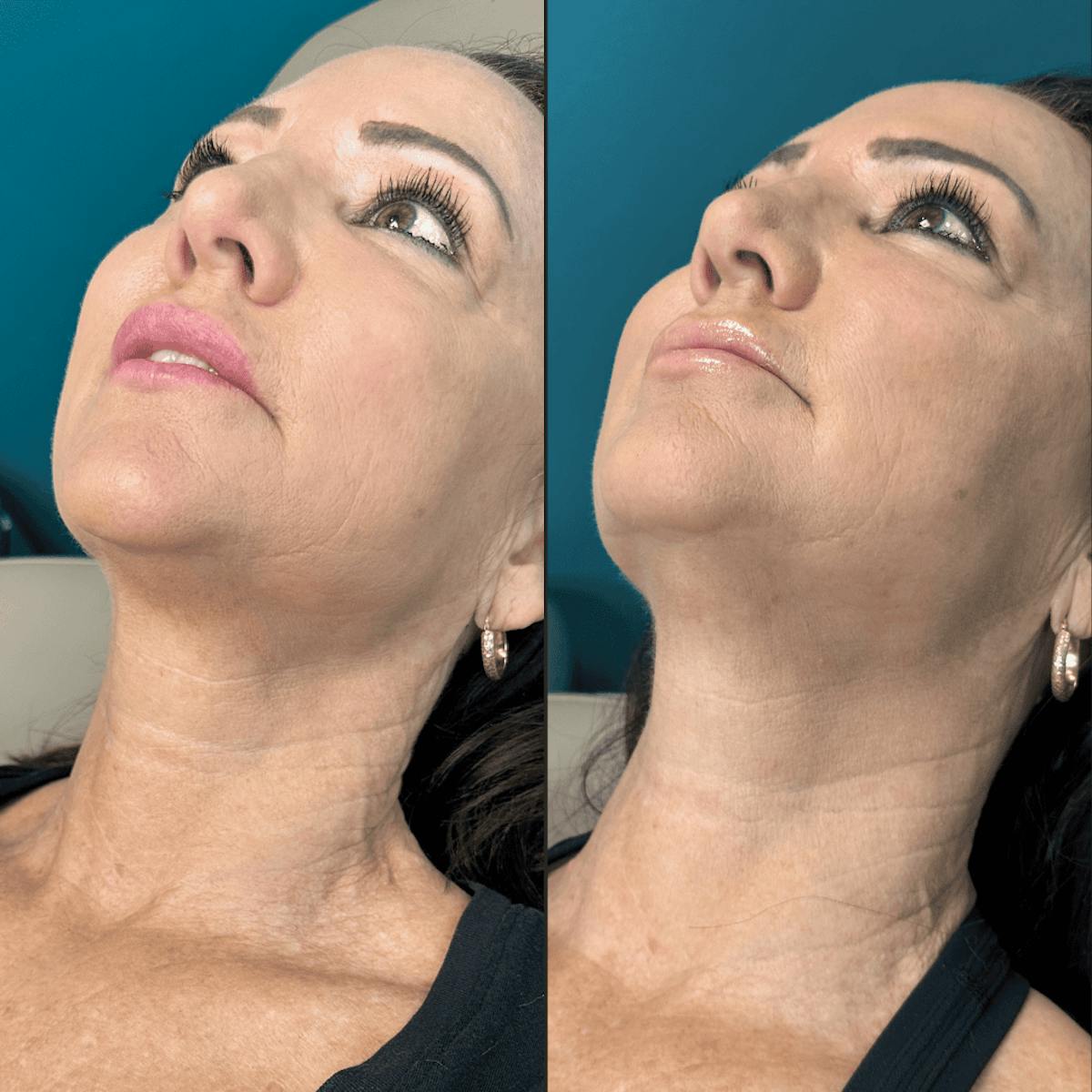 Neck Before & After Gallery - Patient 505320 - Image 10