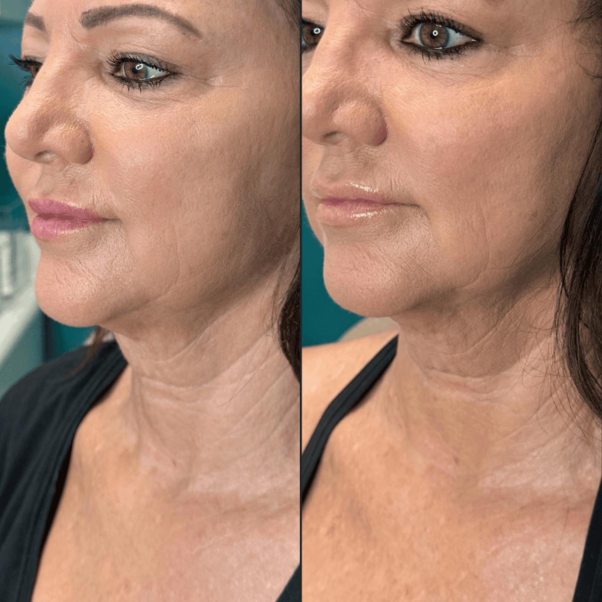 Neck Before & After Gallery - Patient 505320 - Image 6
