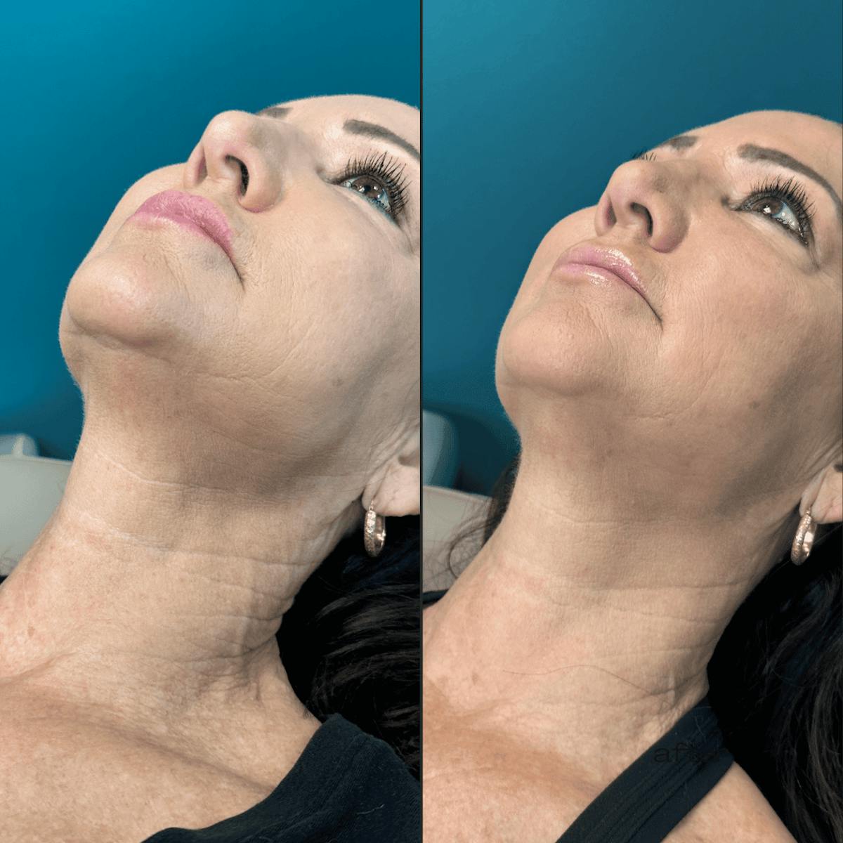 Neck Before & After Gallery - Patient 505320 - Image 9