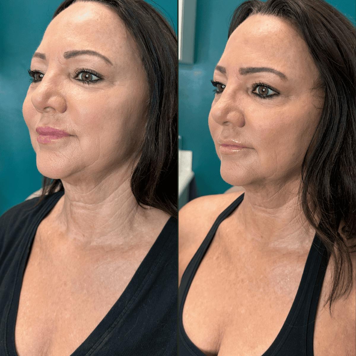 Neck Before & After Gallery - Patient 505320 - Image 14