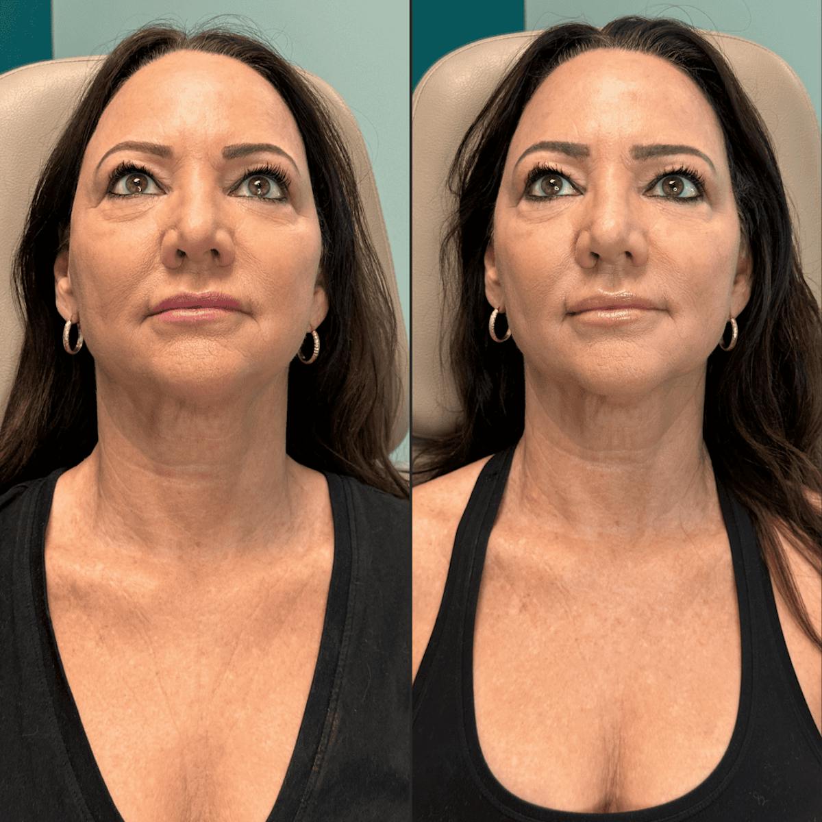 Neck Before & After Gallery - Patient 505320 - Image 8