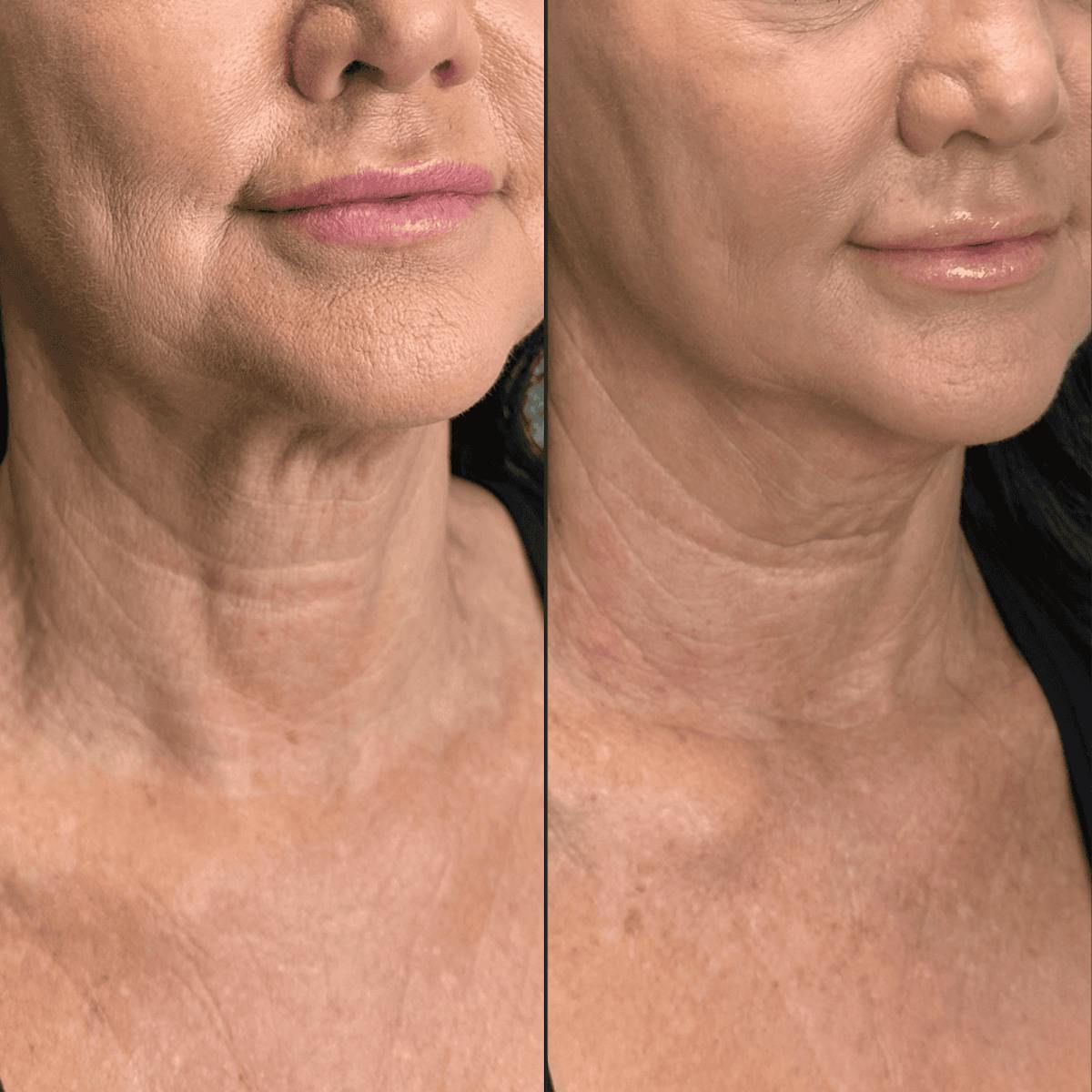 Neck Before & After Gallery - Patient 505320 - Image 7