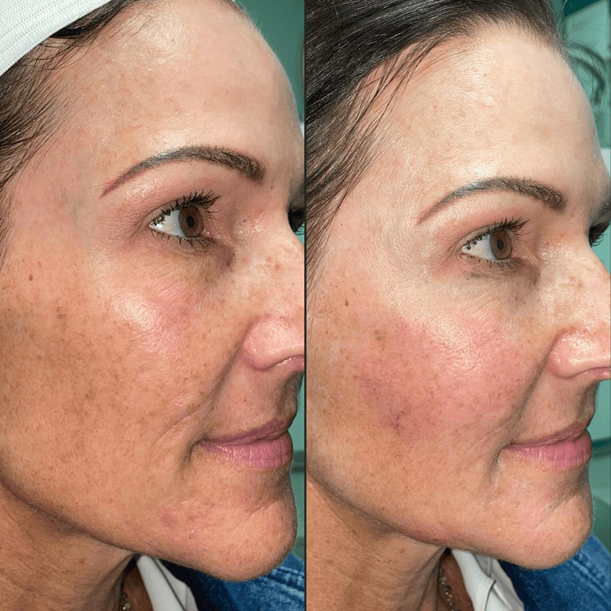 Bellafill Before & After Gallery - Patient 183458 - Image 1