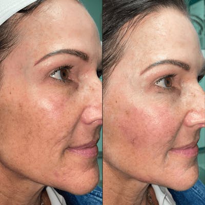 Bellafill Before & After Gallery - Patient 183458 - Image 1