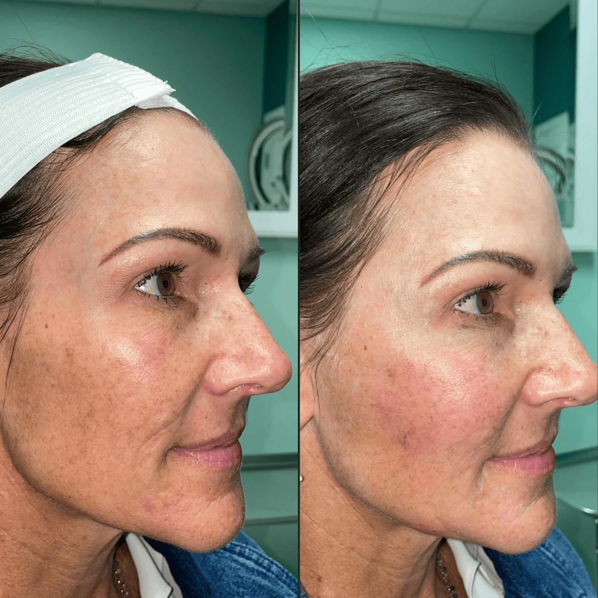 Bellafill Before & After Gallery - Patient 183458 - Image 3
