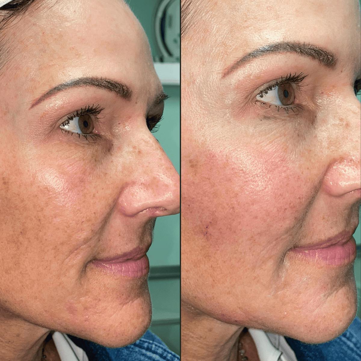 Bellafill Before & After Gallery - Patient 183458 - Image 2