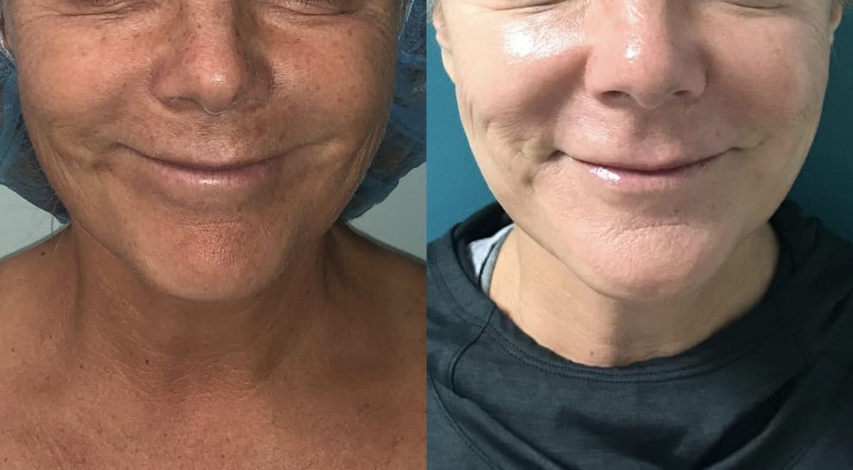 IPL Before & After Gallery - Patient 354417 - Image 1