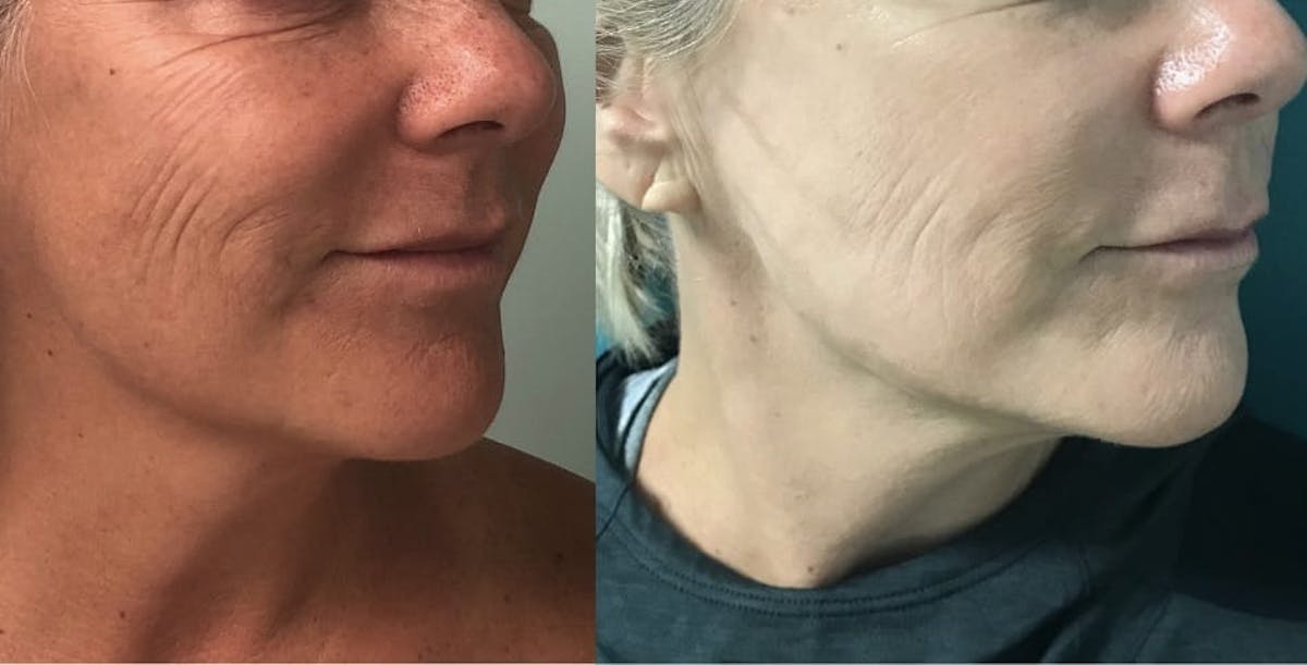 IPL Before & After Gallery - Patient 354417 - Image 2