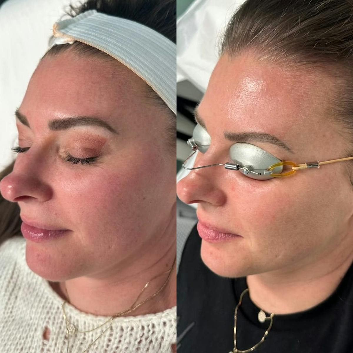 IPL Before & After Gallery - Patient 932997 - Image 1
