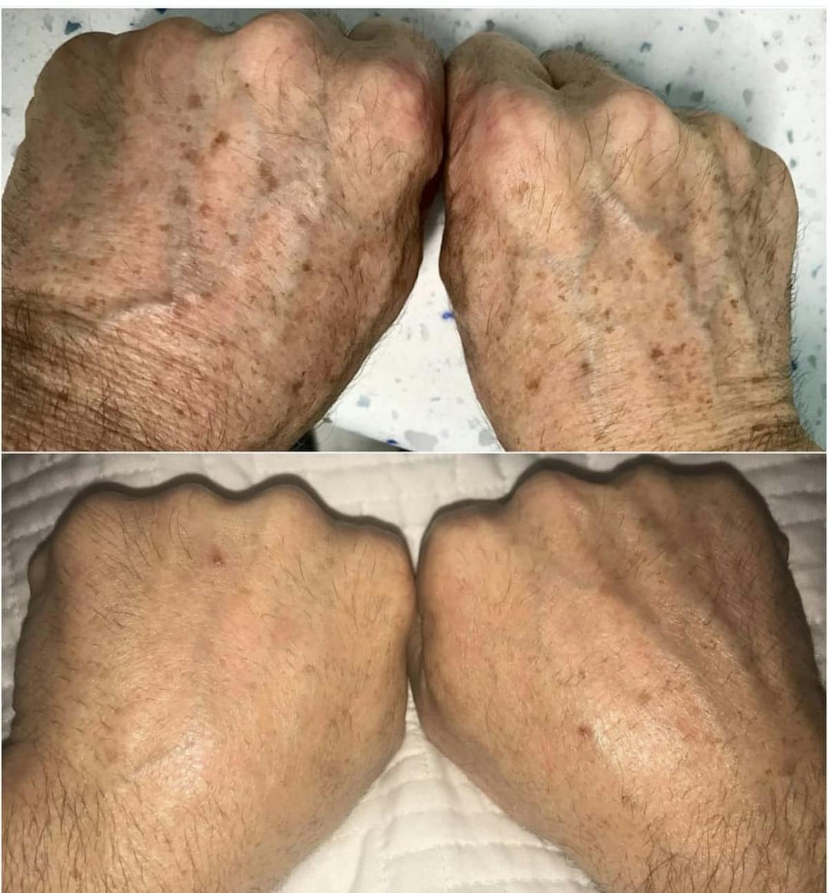 IPL Before & After Gallery - Patient 383526 - Image 1