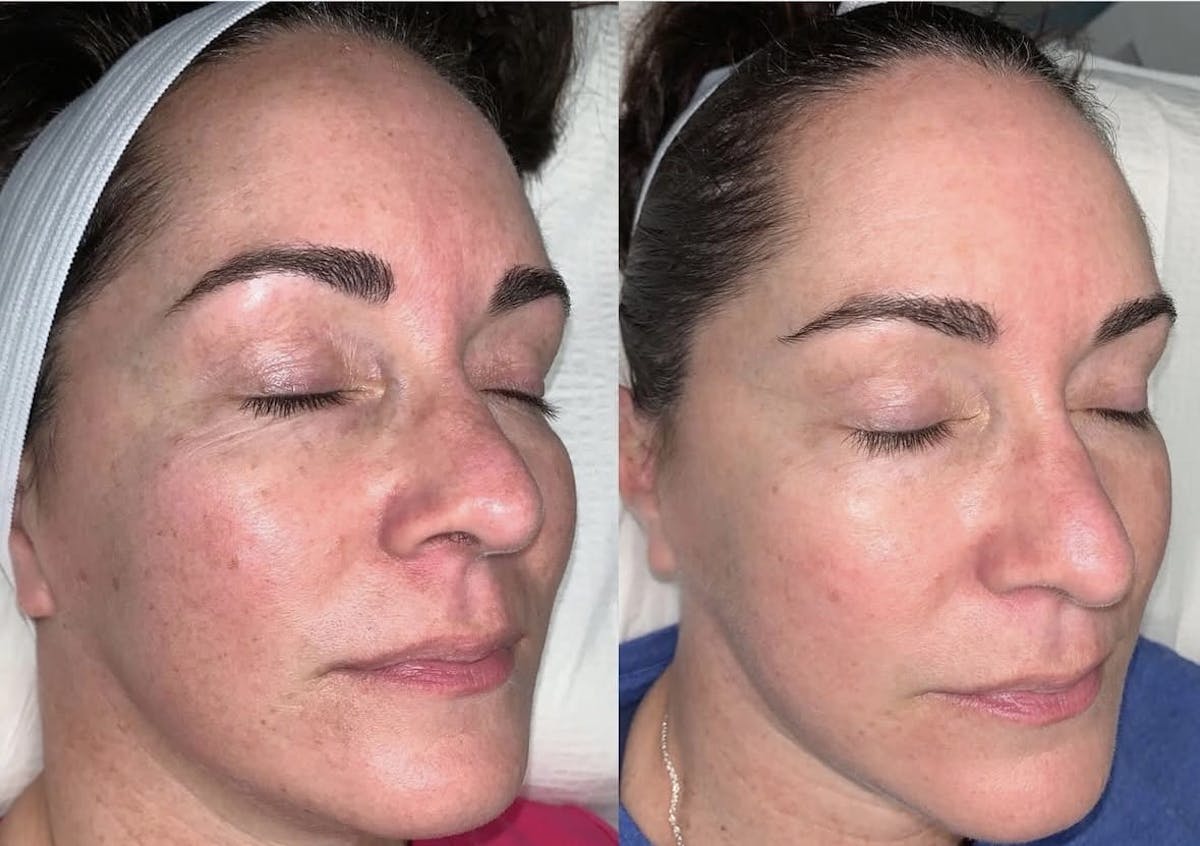 IPL Before & After Gallery - Patient 105734 - Image 1