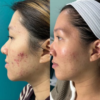 AviClear Before & After Gallery - Patient 266199 - Image 1