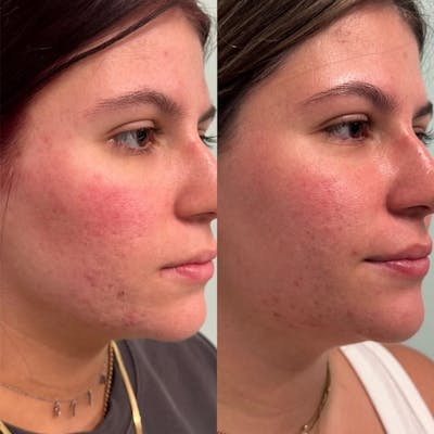 AviClear Before & After Gallery - Patient 403909 - Image 1
