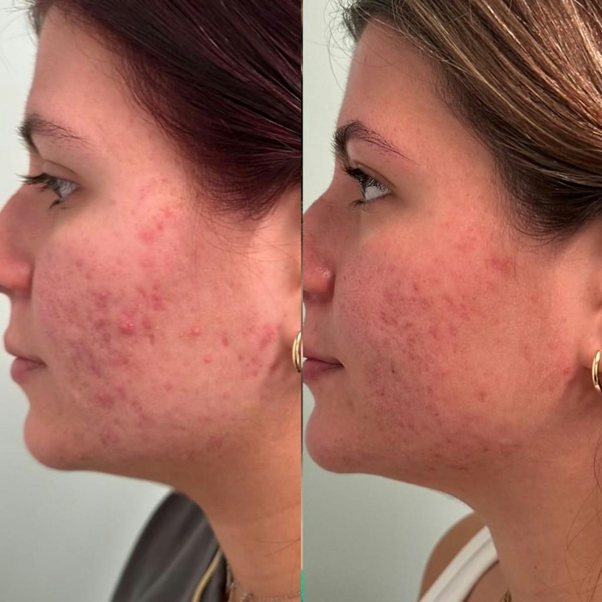 AviClear Before & After Gallery - Patient 403909 - Image 2