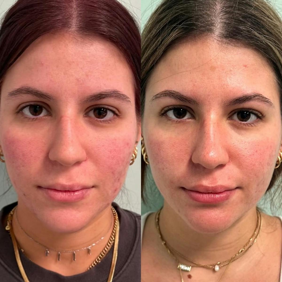 AviClear Before & After Gallery - Patient 403909 - Image 3