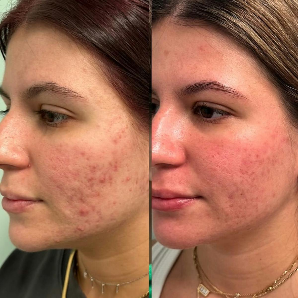 AviClear Before & After Gallery - Patient 403909 - Image 4