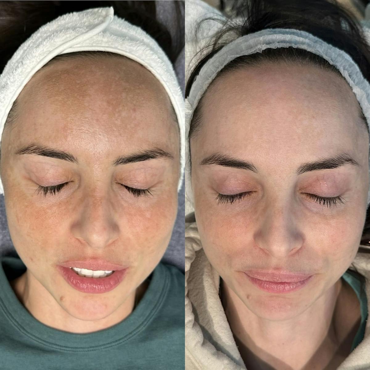 Clear + Brilliant Before & After Gallery - Patient 154028 - Image 3