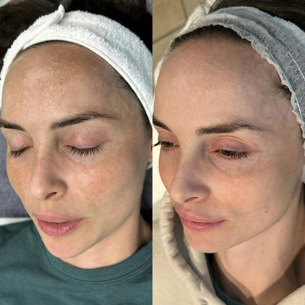 Clear + Brilliant Before & After Gallery - Patient 154028 - Image 2