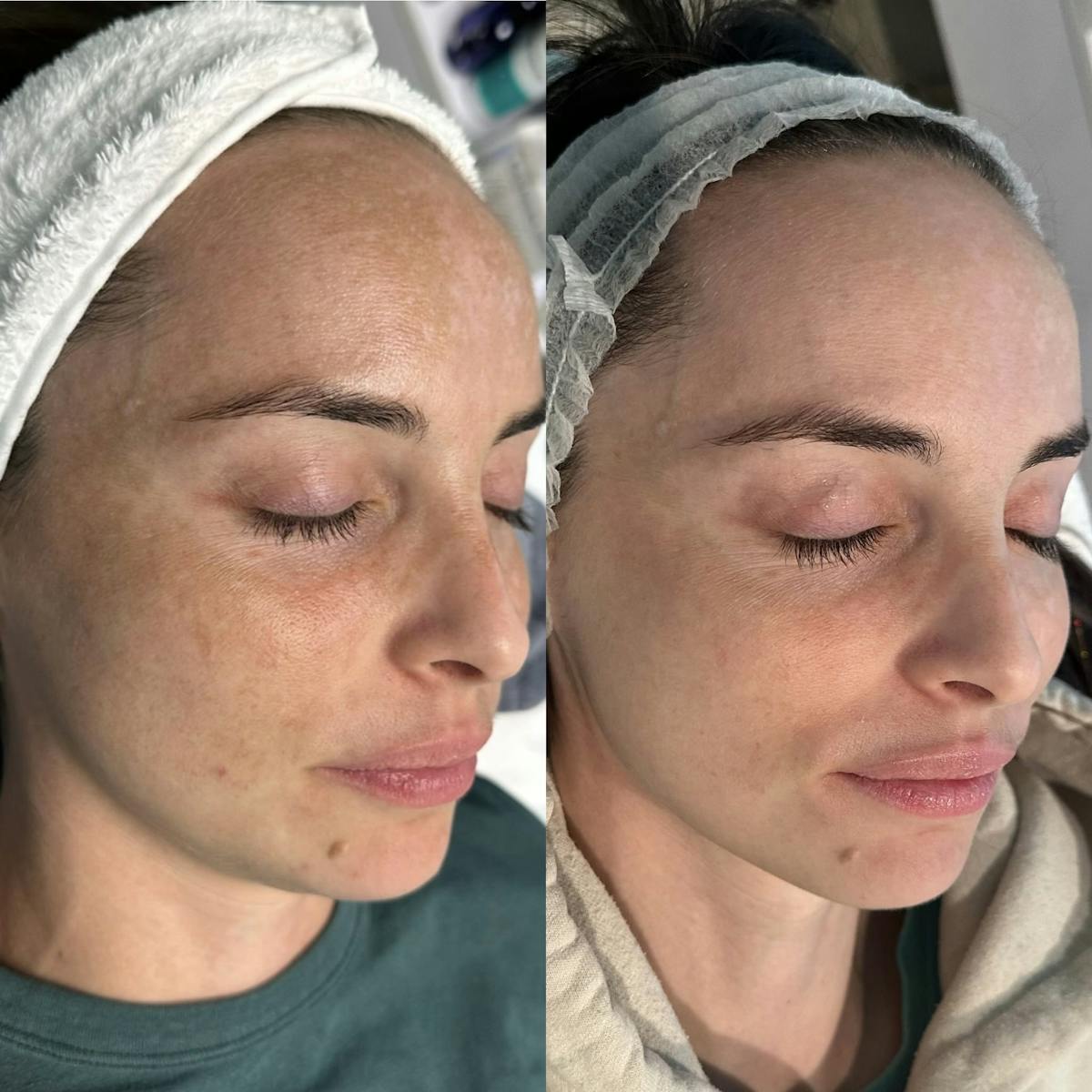 Clear + Brilliant Before & After Gallery - Patient 154028 - Image 1