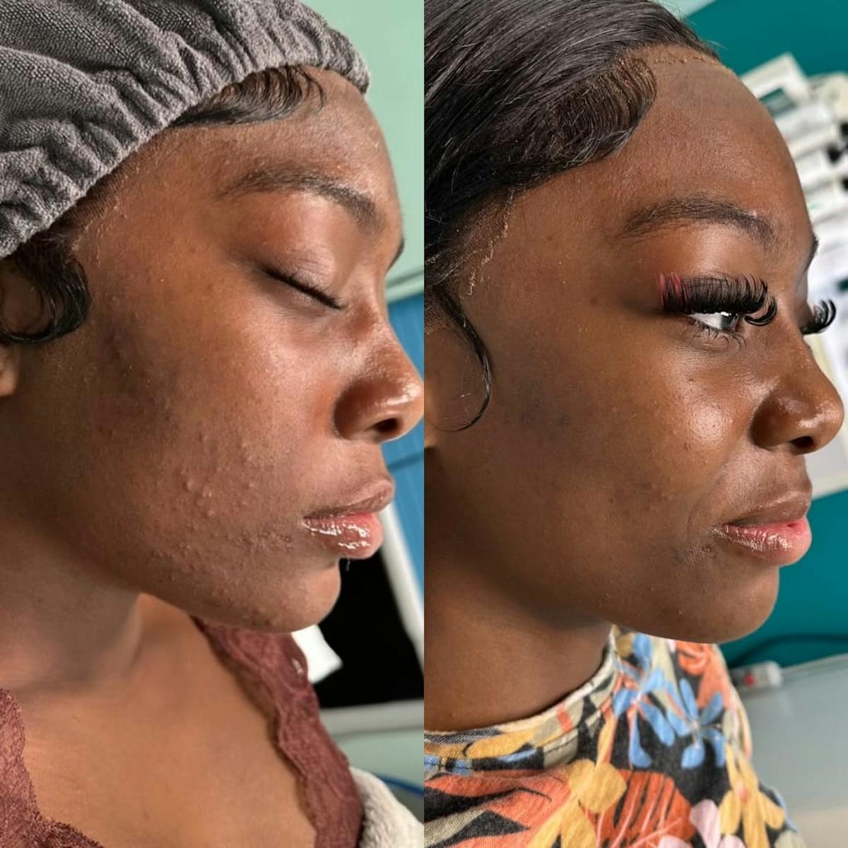 Clear + Brilliant Before & After Gallery - Patient 362589 - Image 3