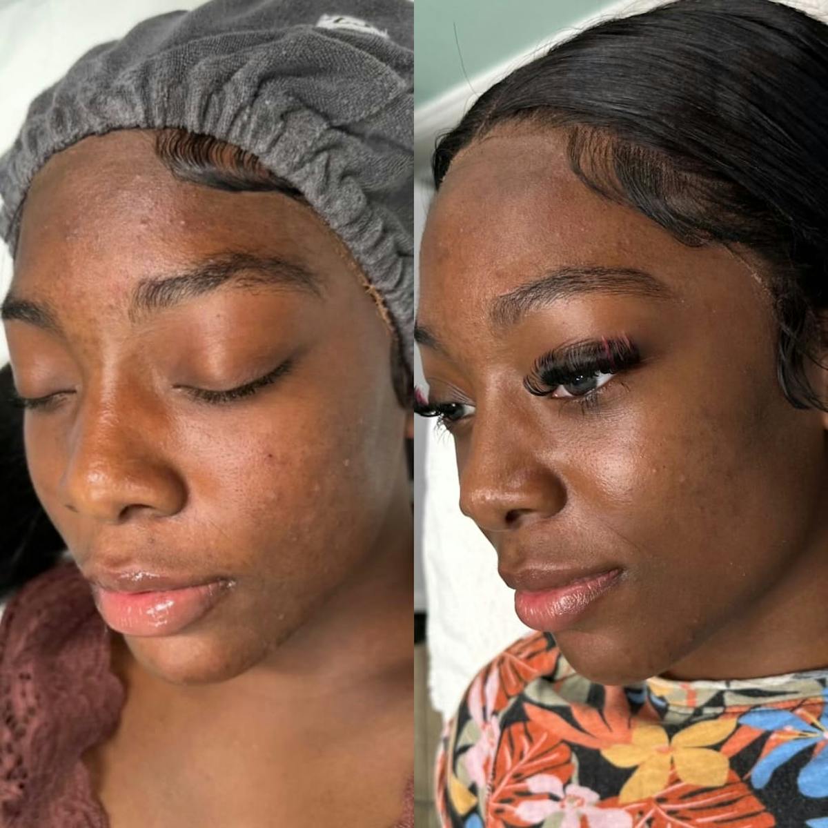 Clear + Brilliant Before & After Gallery - Patient 362589 - Image 1