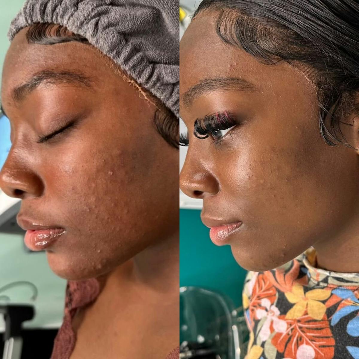 Clear + Brilliant Before & After Gallery - Patient 362589 - Image 2