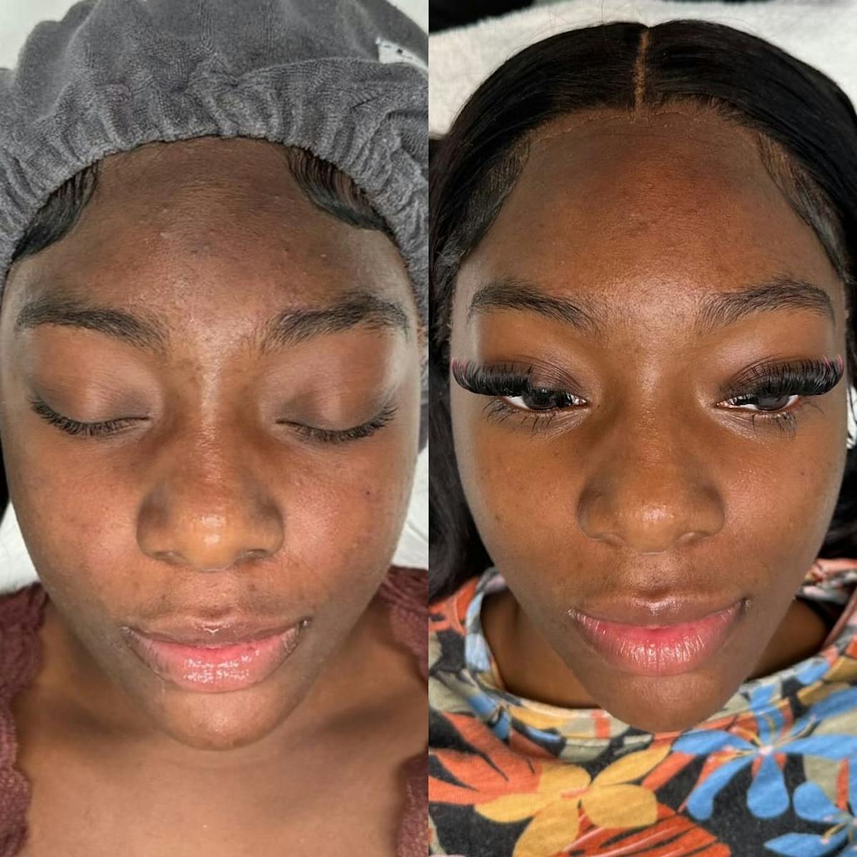 Clear + Brilliant Before & After Gallery - Patient 362589 - Image 4