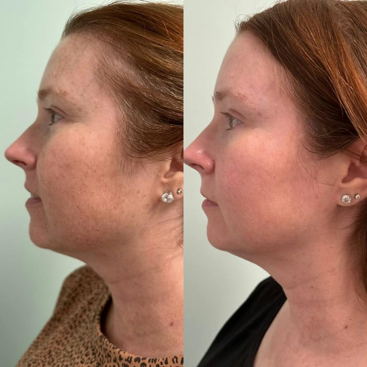 PicoSure Rejuvenation Before & After Gallery - Patient 256795 - Image 1