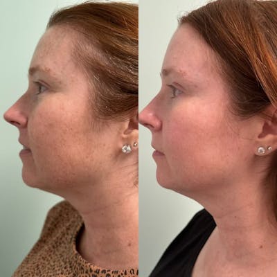 PicoSure Rejuvenation Before & After Gallery - Patient 256795 - Image 1