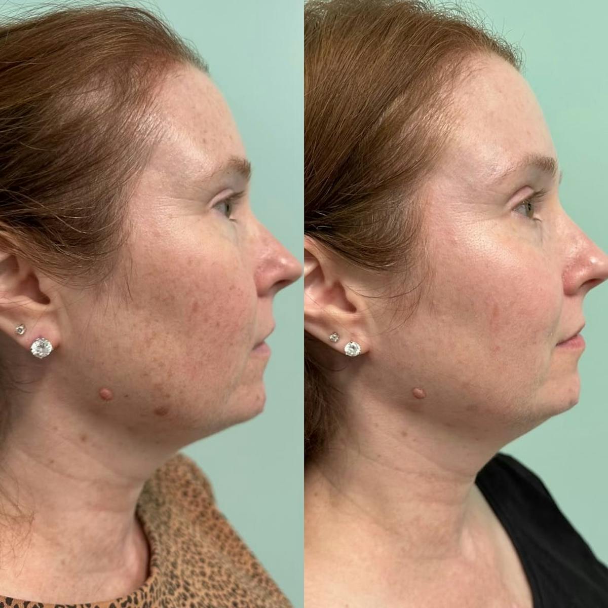 PicoSure Rejuvenation Before & After Gallery - Patient 256795 - Image 4