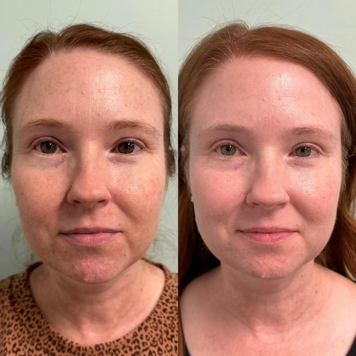 PicoSure Rejuvenation Before & After Gallery - Patient 256795 - Image 2