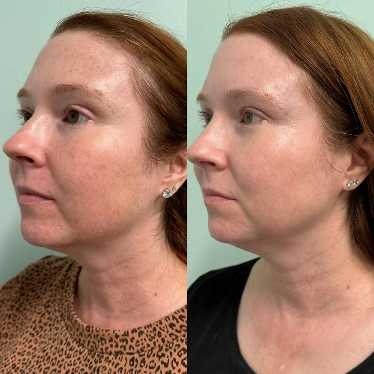 PicoSure Rejuvenation Before & After Gallery - Patient 256795 - Image 3