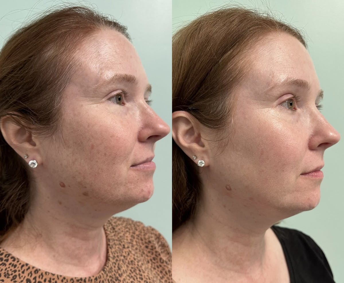PicoSure Rejuvenation Before & After Gallery - Patient 256795 - Image 5