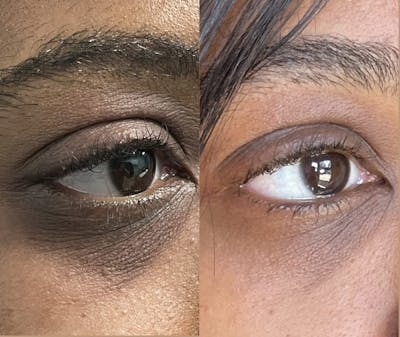 PicoSure Rejuvenation Before & After Gallery - Patient 390832 - Image 1