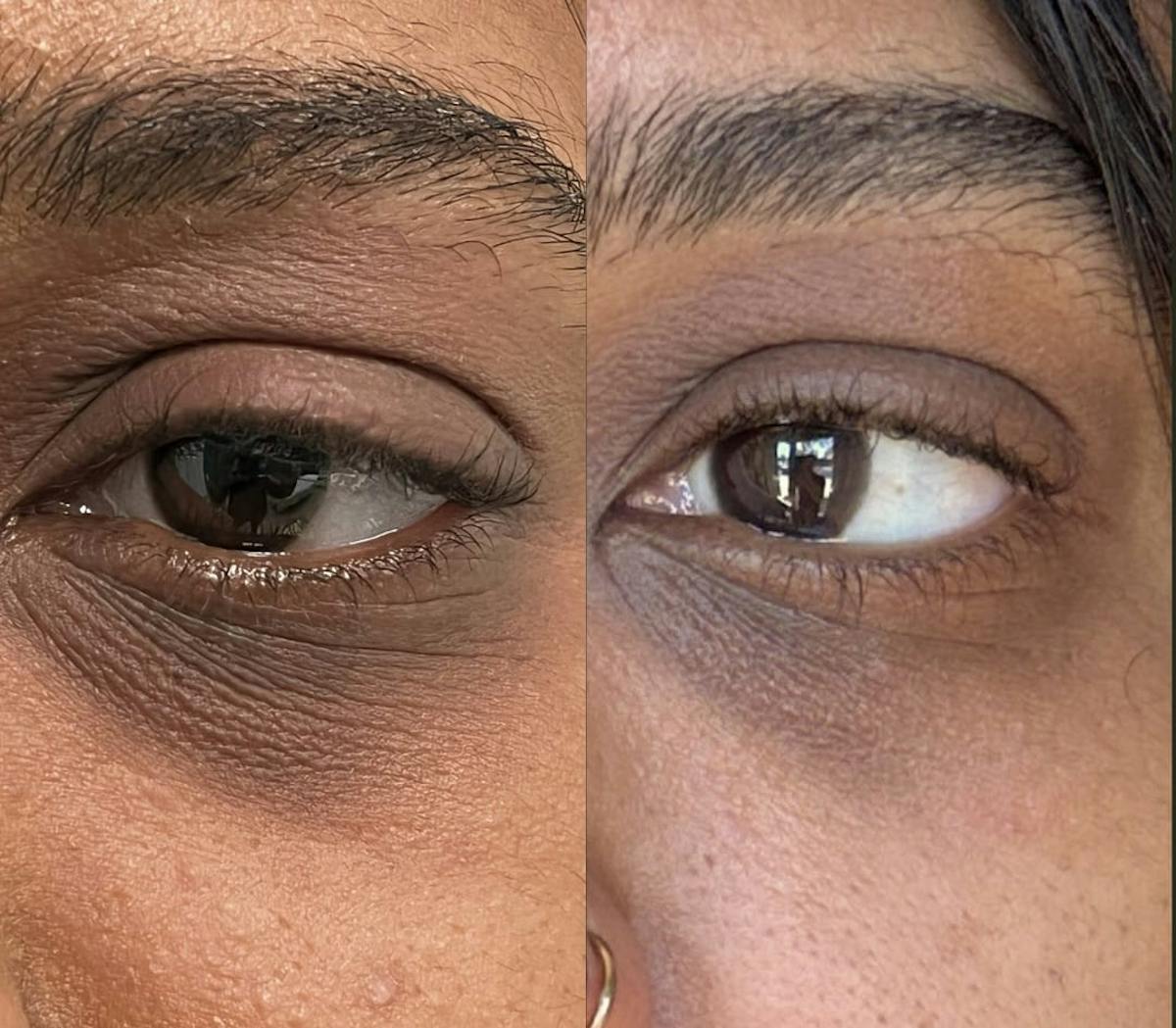 PicoSure Rejuvenation Before & After Gallery - Patient 390832 - Image 2