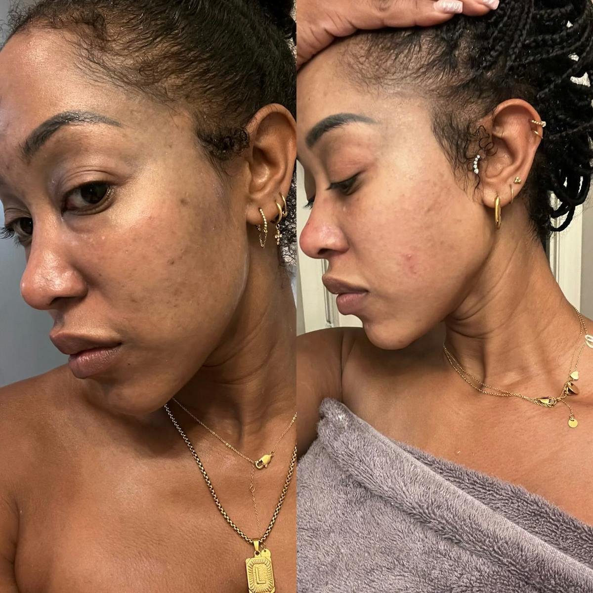PicoSure Rejuvenation Before & After Gallery - Patient 352444 - Image 2