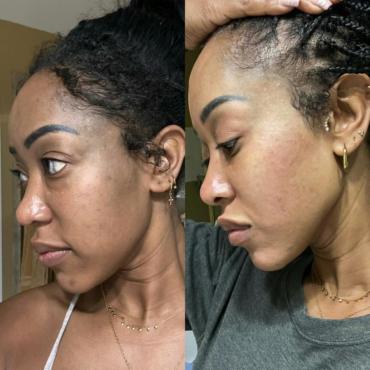 PicoSure Rejuvenation Before & After Gallery - Patient 352444 - Image 1