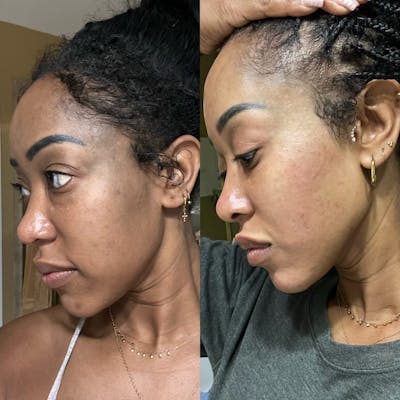 PicoSure Rejuvenation Before & After Gallery - Patient 352444 - Image 1
