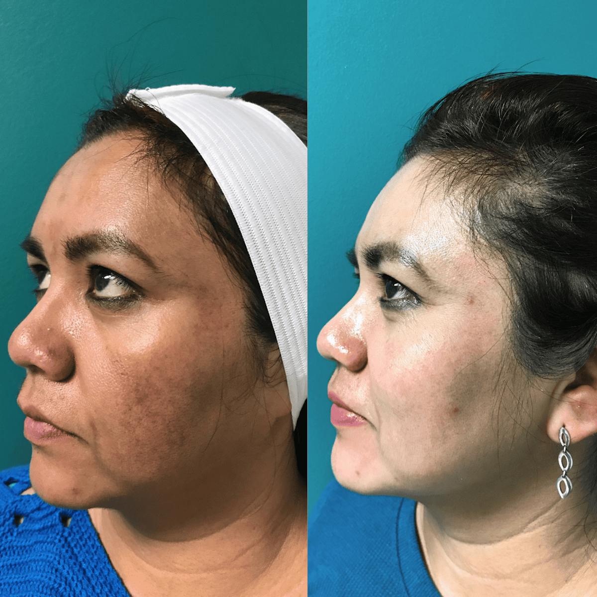 Melange Peel Before & After Gallery - Patient 110719 - Image 3