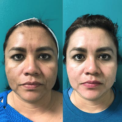 Melange Peel Before & After Gallery - Patient 110719 - Image 1