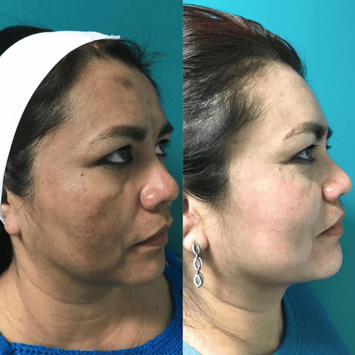 Melange Peel Before & After Gallery - Patient 110719 - Image 2