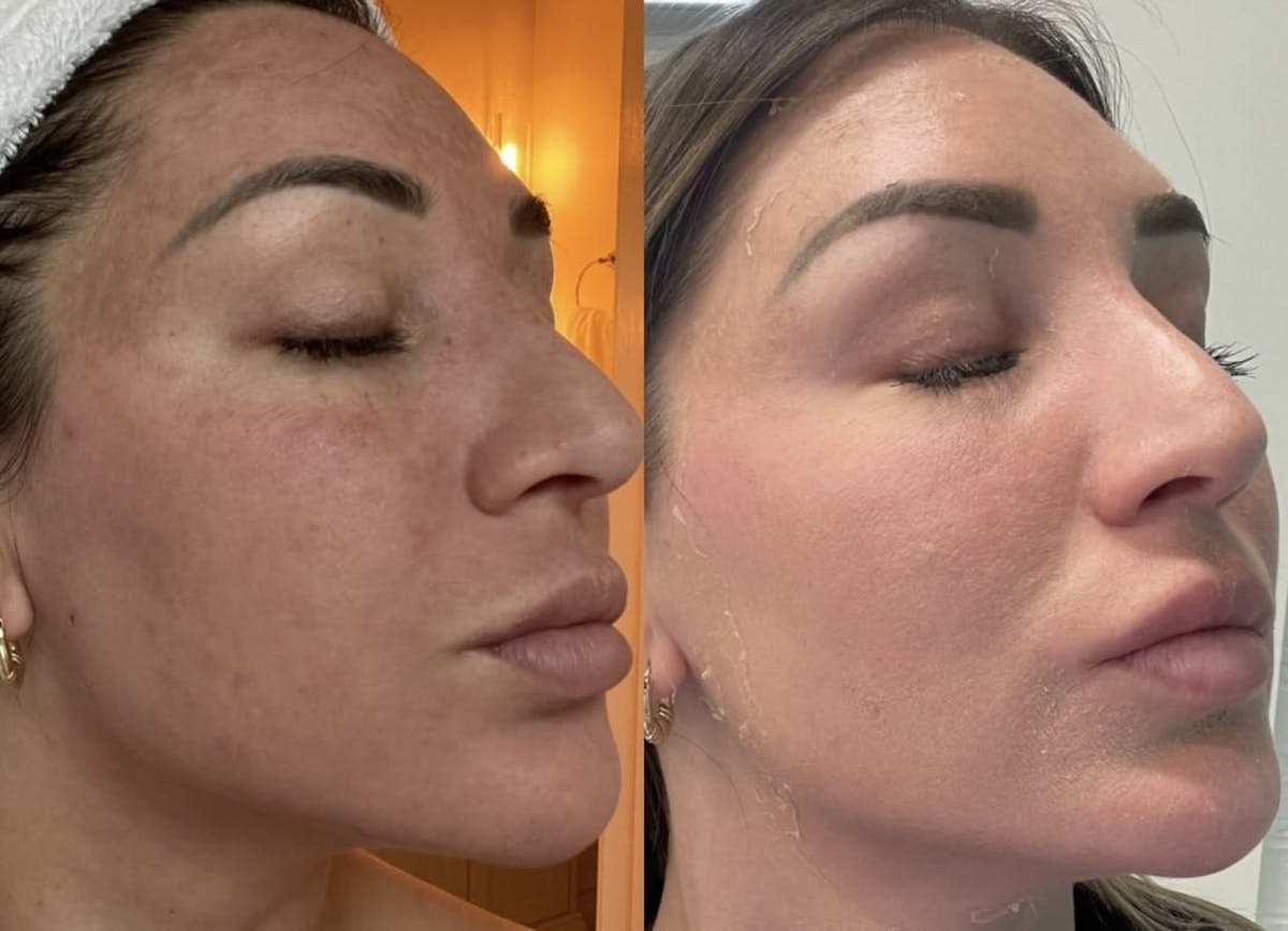 Melange Peel Before & After Gallery - Patient 250210 - Image 1
