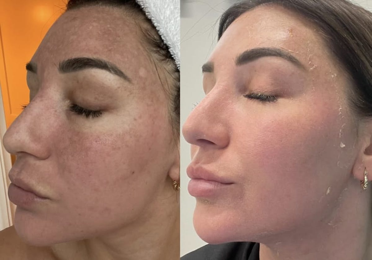 Melange Peel Before & After Gallery - Patient 250210 - Image 2