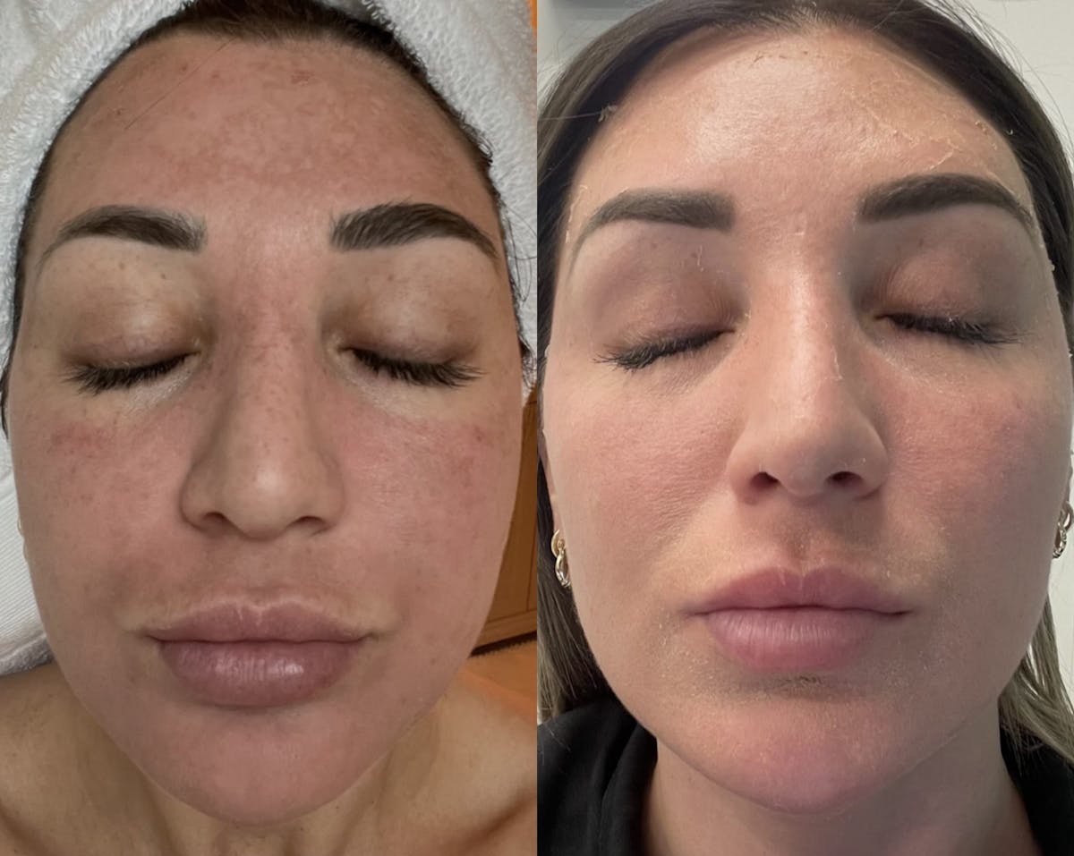 Melange Peel Before & After Gallery - Patient 250210 - Image 3