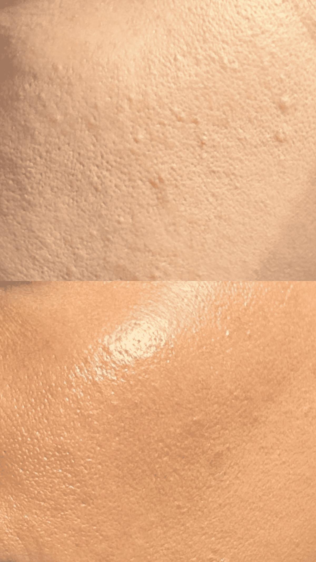 Microneedling Before & After Gallery - Patient 167725 - Image 1